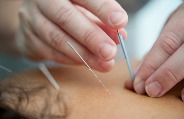 Dry needling toepassing op rug